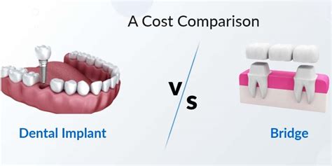 Dental Implant Cost & Comparisons .